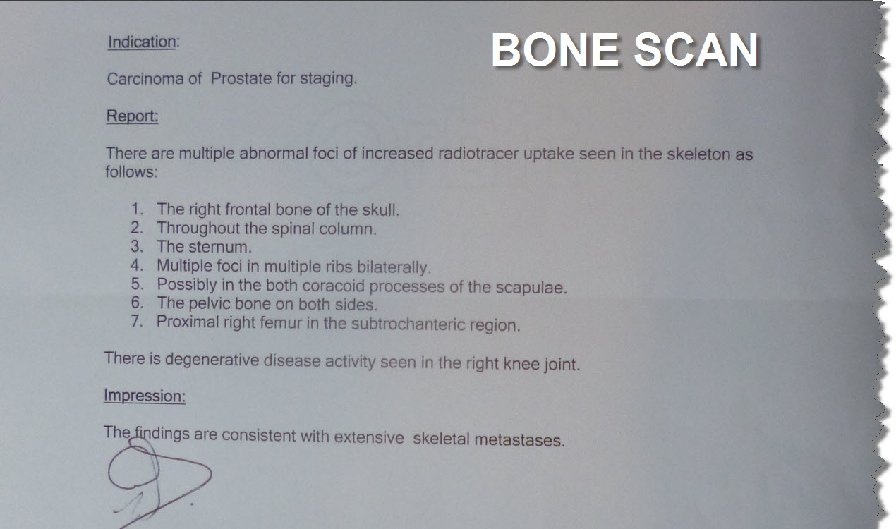 YMT bone scan for advanced prostate cancer